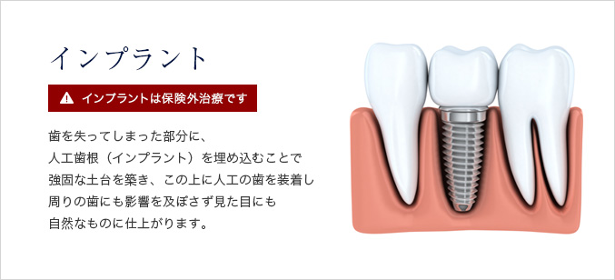インプラント 歯を失ってしまった部分に、人工歯根（インプラント）を埋め込むことで強固な土台を築き、この上に人工の歯を装着し周りの歯にも影響を及ぼさず見た目にも自然なものに仕上がります。